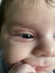 CMPA rash or acne/dermatitis?