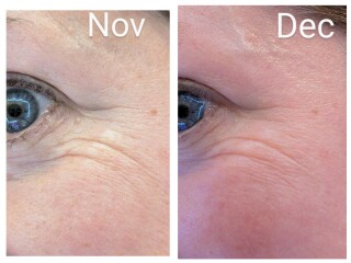 Tretinoin 0.006 - I think I can see an improvement already!! (Pic)