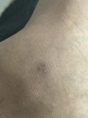 Bed bugs? What is this bite?