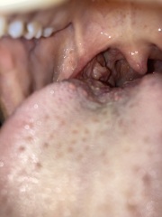 Tonsil Cancer? Any experience or knowledge? *PICTURE*