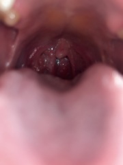 Red bump in back of throat