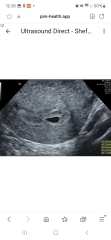 No yolk sac on scan