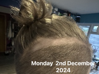 Hair Loss in an 11 year old