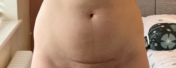 Second C Section Recovery