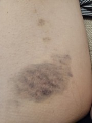 Large areas of bruising on thighs