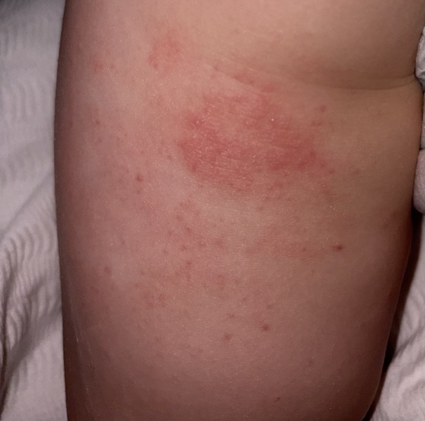 Natural cream for excema