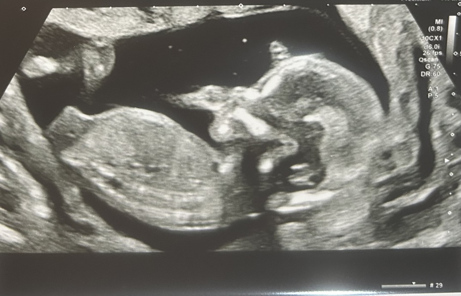 Boy or girl predictions from scan?