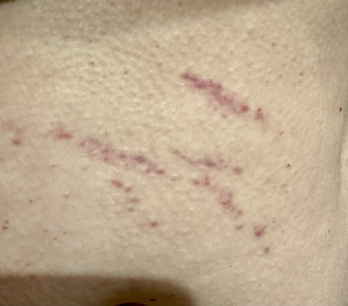Pink/purple marks on stomach
