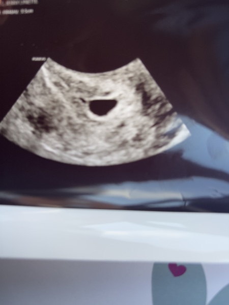 No fetal pole 6 weeks - success story!!