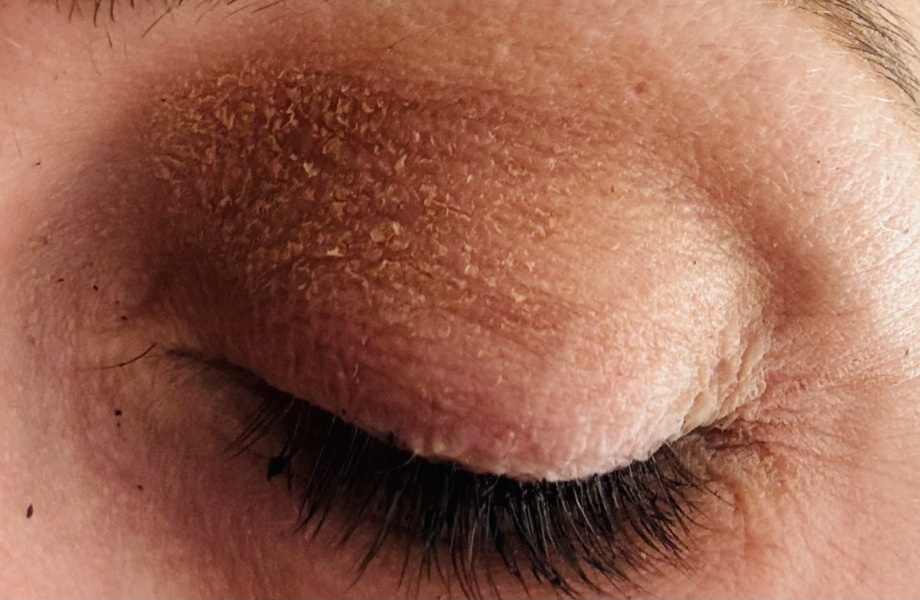 Eyelids with elephant looking skin!
