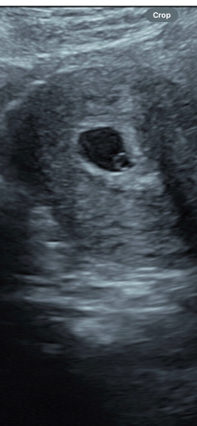 6 Week Scan empty gestational sac