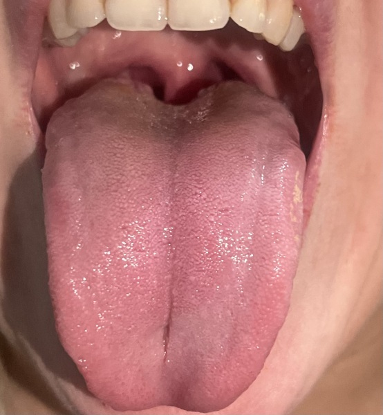 To ask for your opinion on my sore throat - pic included