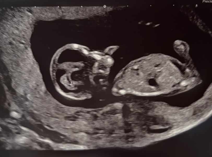 Worried about my 12 week scan photo!