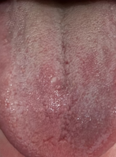 Is this oral thrush ? Adult (photo)