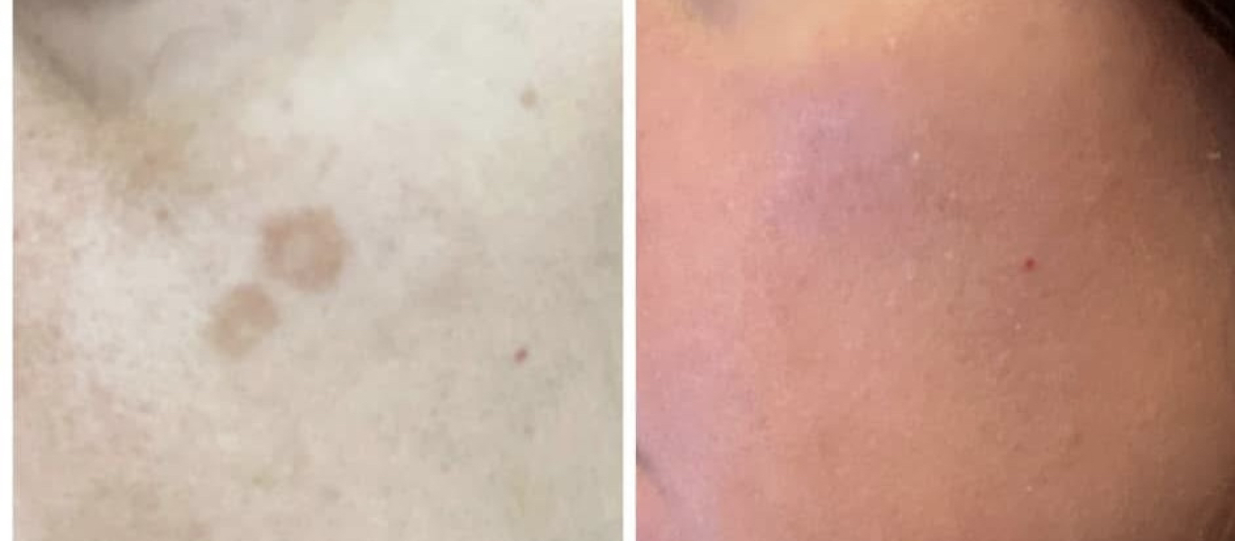 Anyone discovered a dark spot treatment
