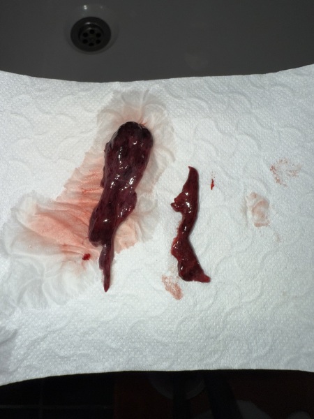 Just passed this one week post medical abortion, panicking? (Sensitive photo attached)