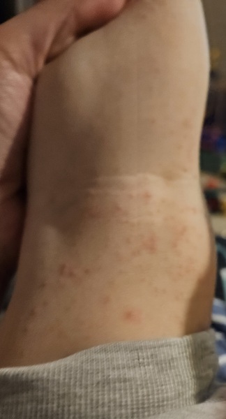 Chickenpox...?
