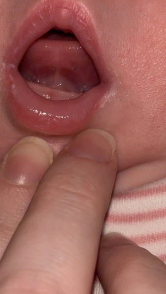 Does this look like tongue tie?
