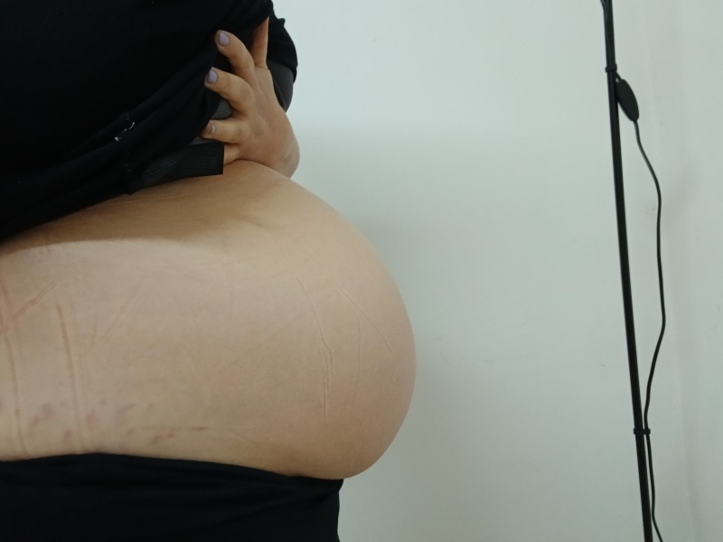 Fibroid belly.