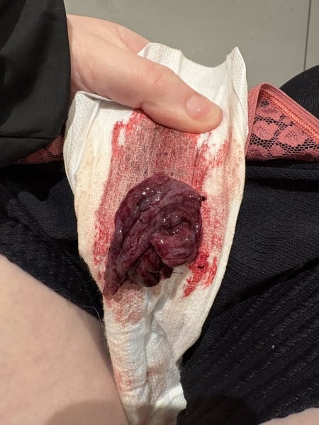 Graphic photo in post - 7 weeks miscarriage?