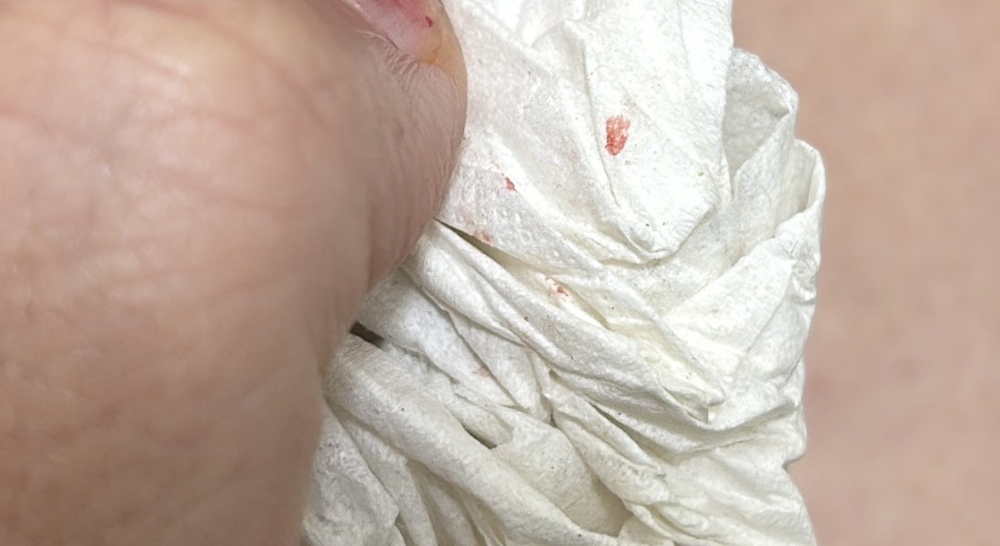 Spotting and reduction of symptoms (warning picture)