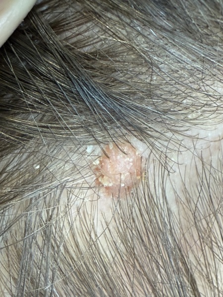 Weird looking mole on scalp