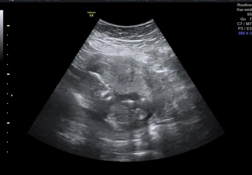 Gender scan at 15 week pics! ❤️