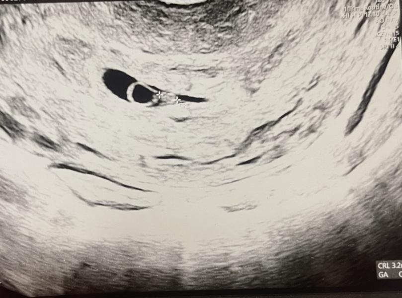 Bubble in scan