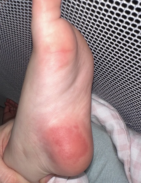 2 year old red dry heel