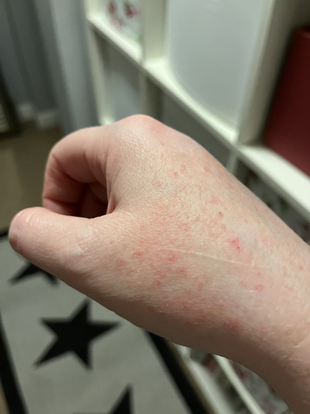 Help me save my scaly hands