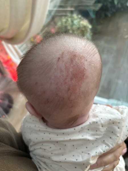 Blood on bed now carpet burn type on head?