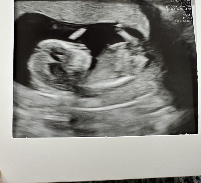 13+1 week scan boy or girl? ❤️