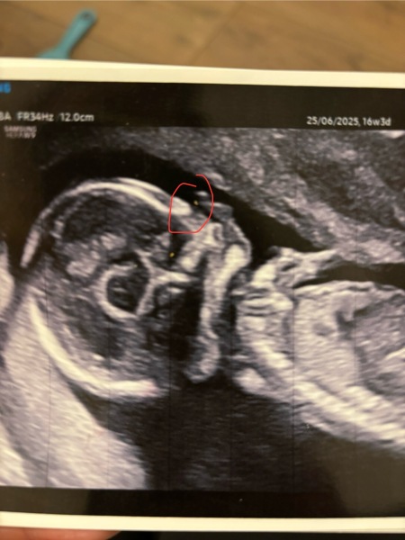 There’s a nasal bone here right?