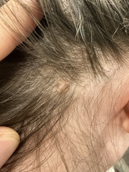Weird looking mole on scalp