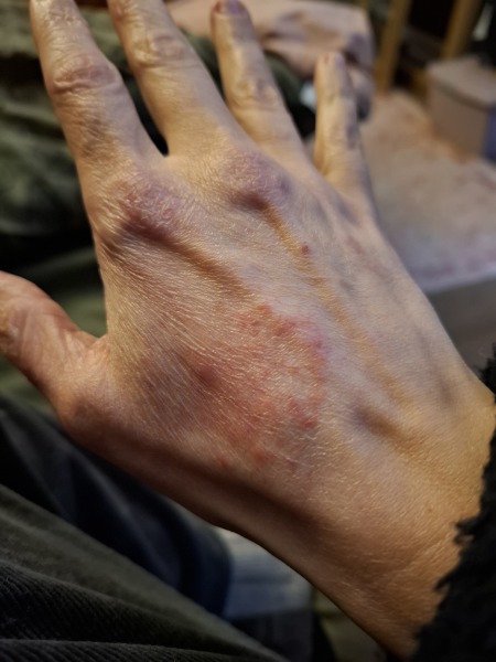 Hand infected (Warning, gross photos)