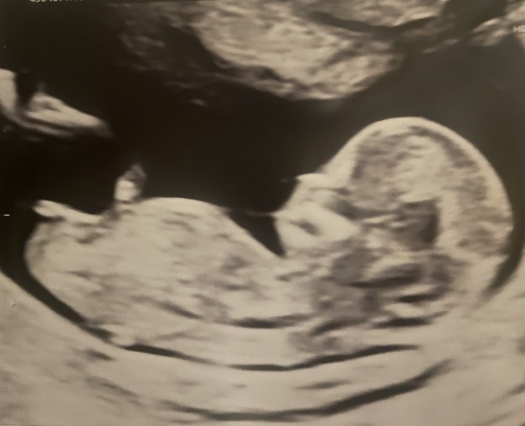 Nub theory - any guesses on the baby’s sex?