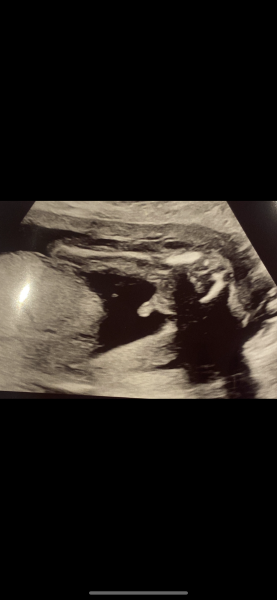 Gender scan at 15 week pics! ❤️