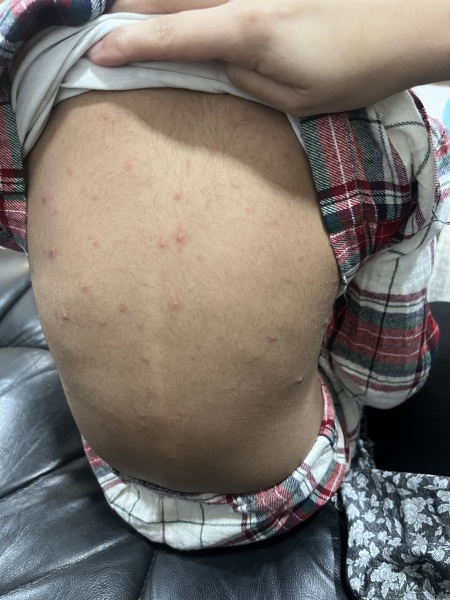 Are these chickenpox?