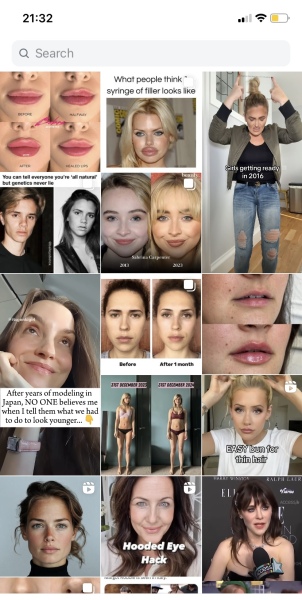 Why do people get massive amounts of lip filler?
