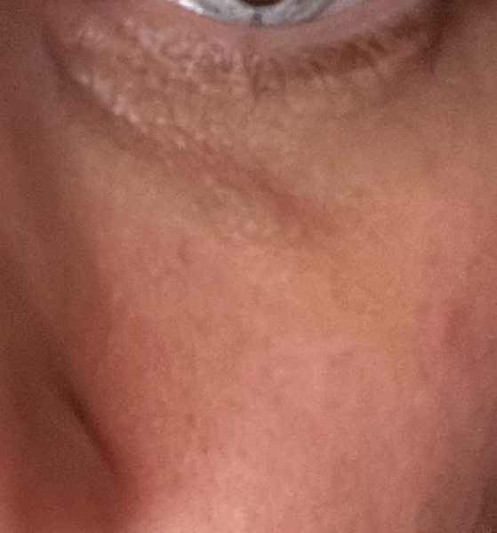 To think my under eye filler looks awful?