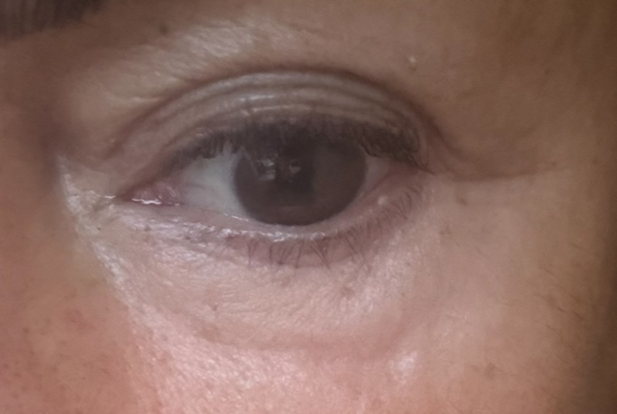 Puffiness under eye 3 months after polynucleotide treatment