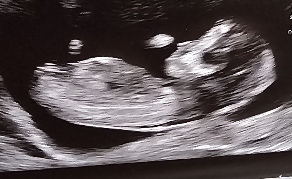 4 weeks 6 days, due 9 July 2024.. anyone wanna join?