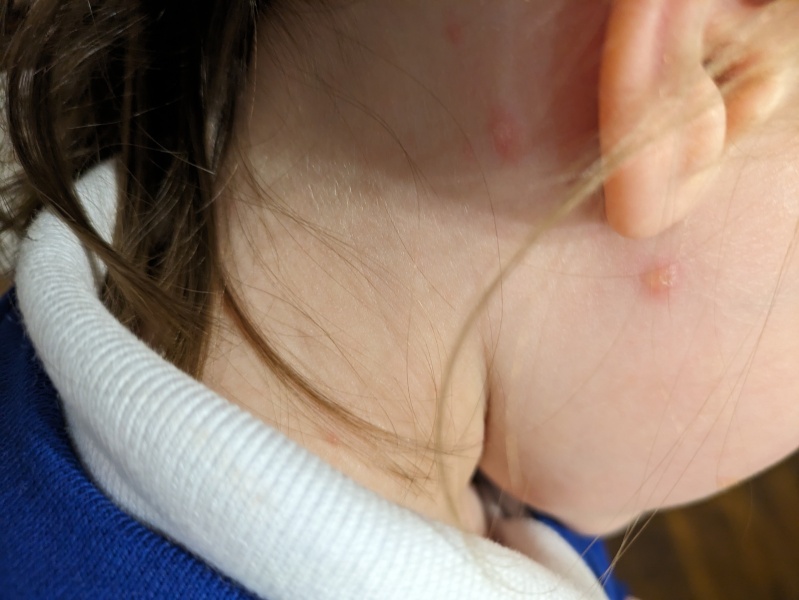 Chickenpox...?