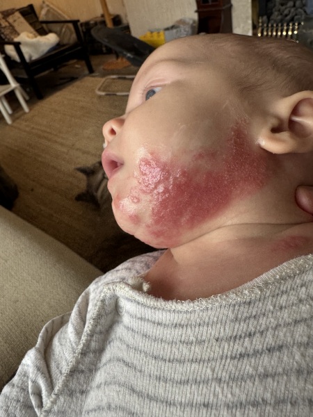 allergy or other rash?