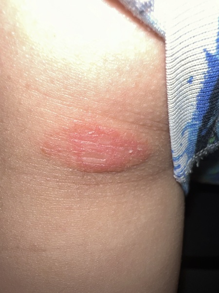 What’s this on my child skin 😭😭😭