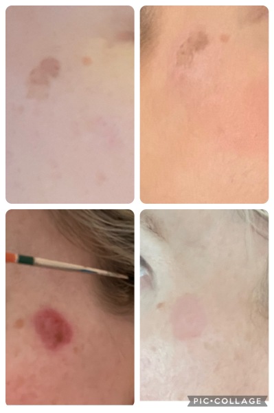 Anyone discovered a dark spot treatment