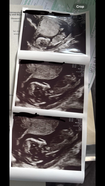 Placenta size