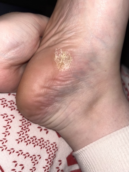 What’s on my foot?