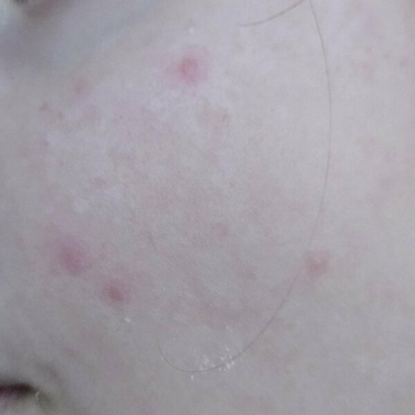 Reoccurring spots on face