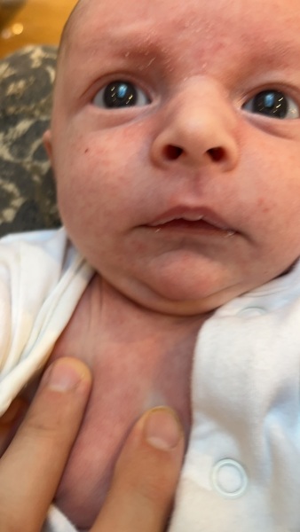 Rash newborn, face and neck